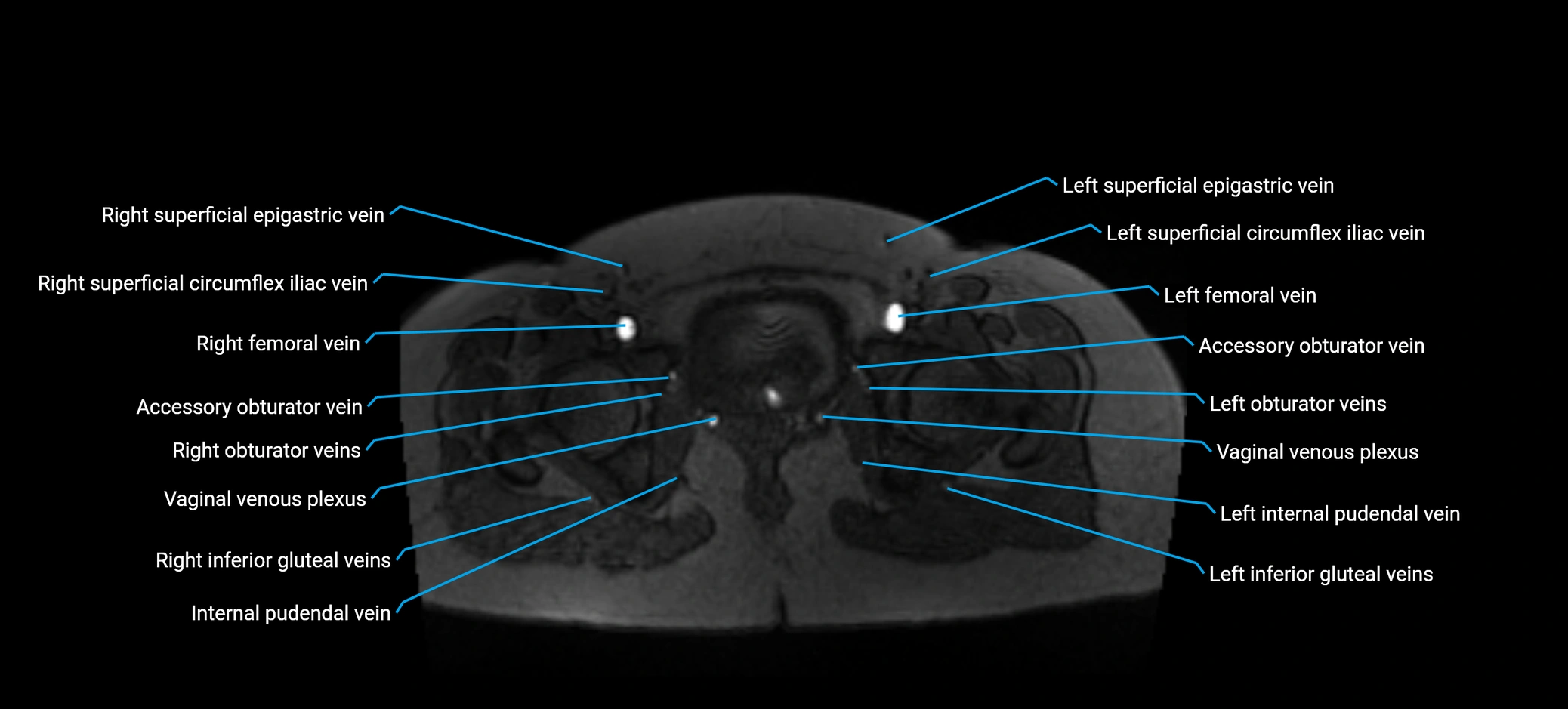 MRV abdomen pelvis & lower limb axial cross sectional anatomy labelled MRI image 184 (1).webp